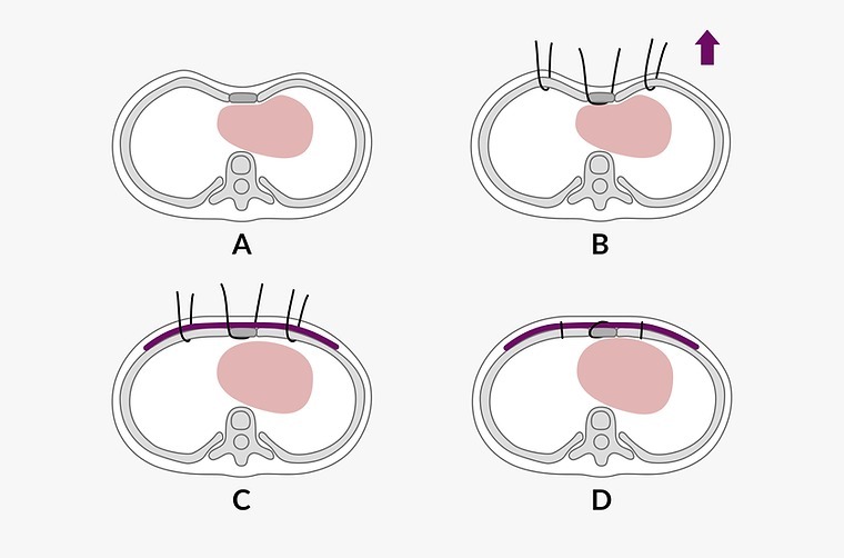 Schematic drawing of the Wang procedure