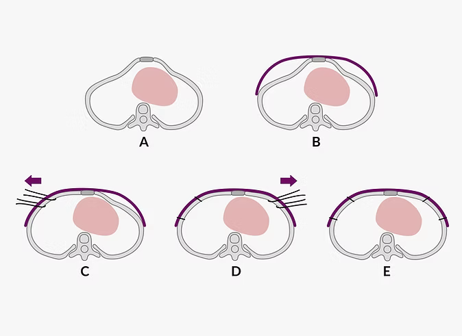 Schematic drawing of the Wenlin procedure