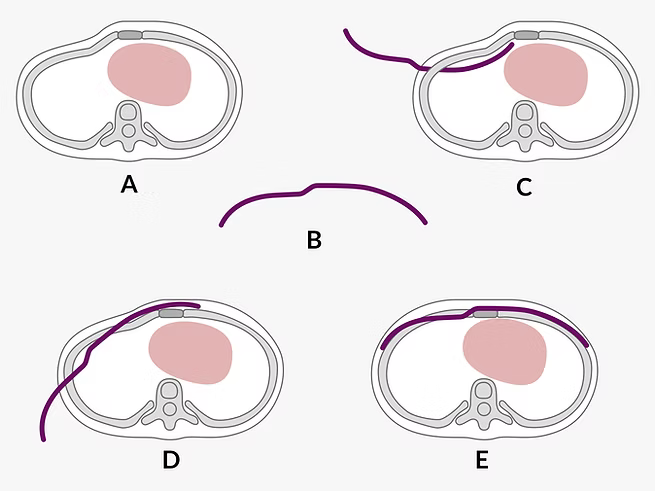 Schematic drawing of the Willine procedure