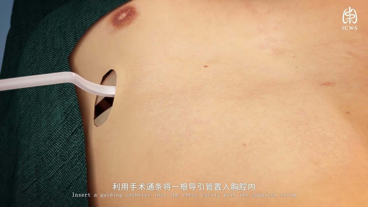 Wung Procedure